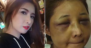Vợ Hotgirl bị chồng đánh biến dạng khuôn mặt ở Thái Lan