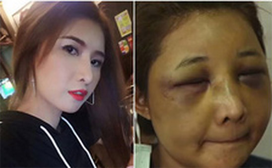 Vợ Hotgirl bị chồng đánh biến dạng khuôn mặt ở Thái Lan